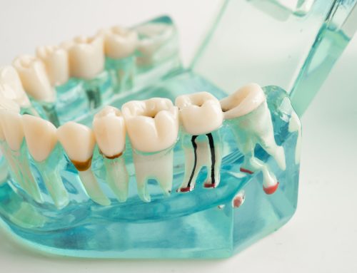 “A tooth I thought was treated has a cavity again?” Causes and prevention of secondary caries (recurrent cavities)