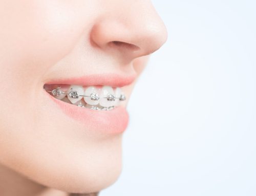 How to Prevent Cavities During Orthodontic Treatment: The Importance of Self-Care and Professional Cleaning (Airflow)