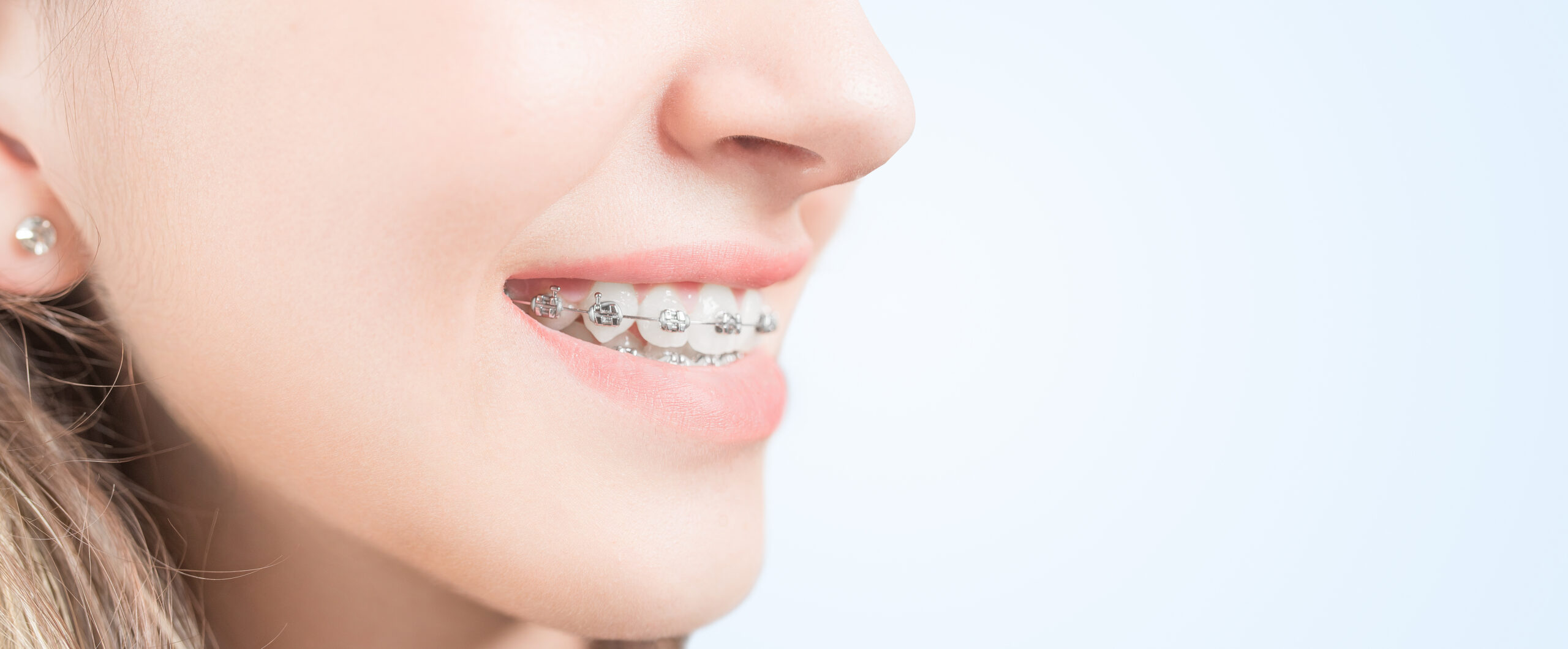 ワイヤー矯正 ワイヤー矯正