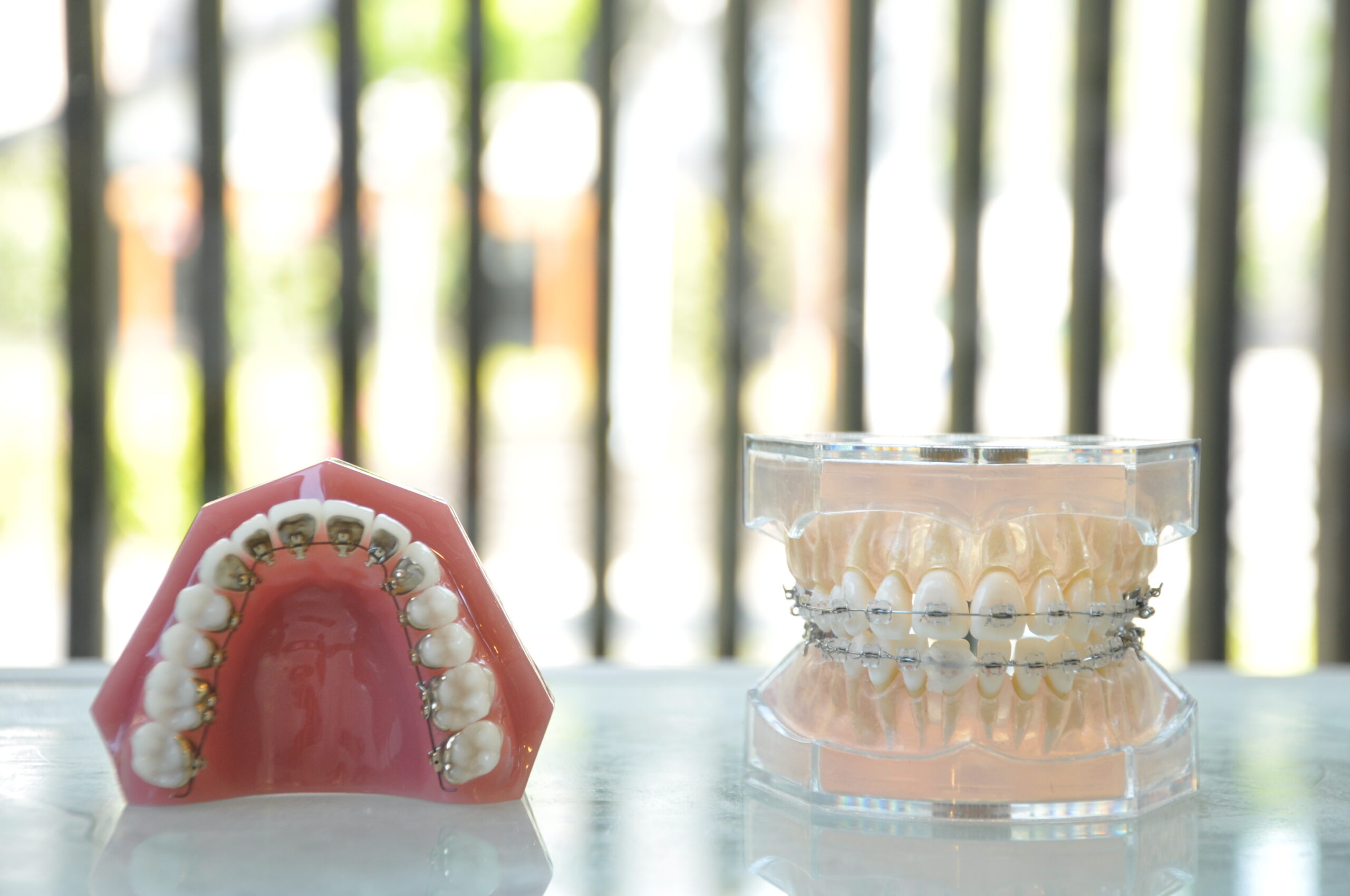 リンガル矯正 リンガル矯正