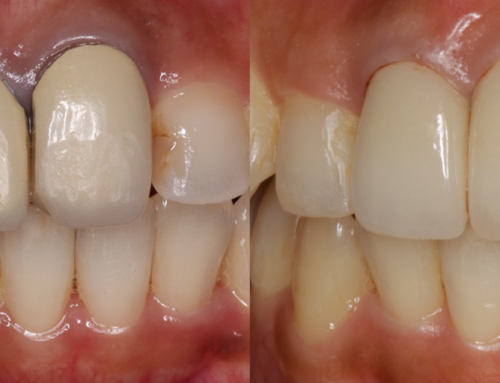 앞니의 ‘검은 선’이 신경 쓰이시는 분! 블랙 마진 해결 방법