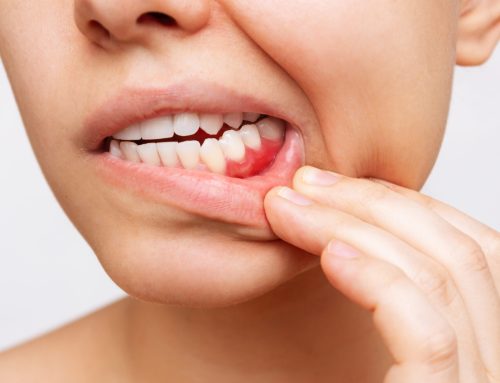 Is it safe to ignore swollen or bleeding gums? Differences between gingivitis and periodontal disease, and key points for prevention.