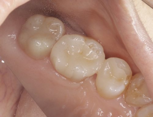 오래된 은니, 모르는 사이에 맞지 않게 되지 않으셨나요?